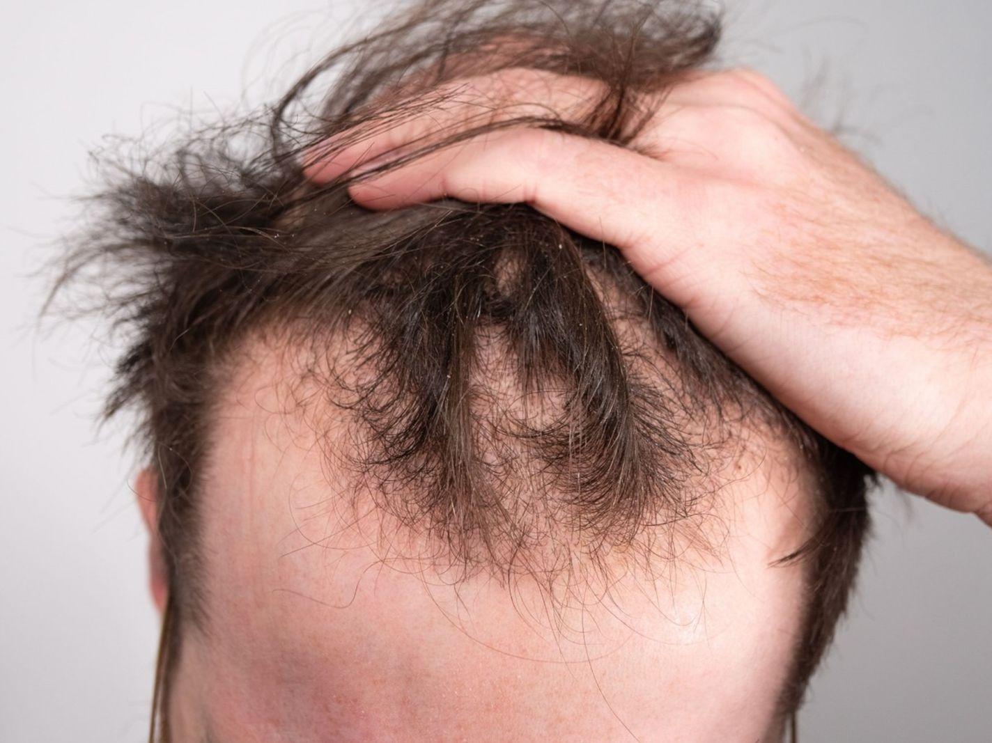 علائم ریزش مو را بشناسید|بهترین راه‌های درمان ریزش مو